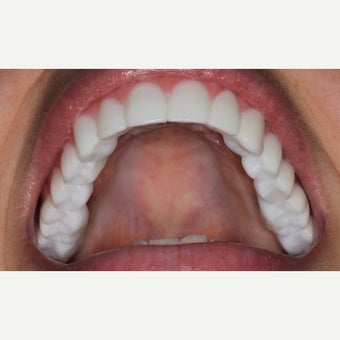 25-34 year old woman treated with All-on-4 Dental Implants after 2184199
