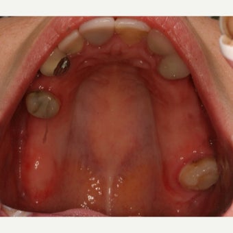 25-34 year old woman treated with All-on-4 Dental Implants before 2184199