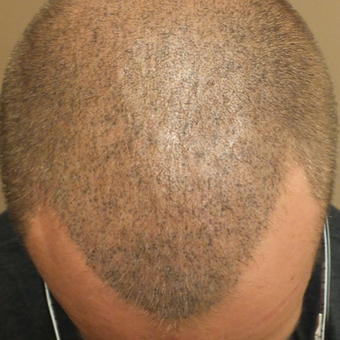 25-34 year old man treated with Scalp Micropigmentation after 2810921