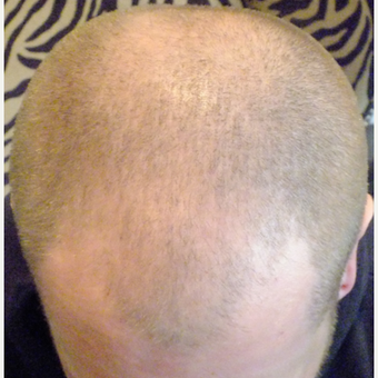 25-34 year old man treated with Scalp Micropigmentation before 2810921