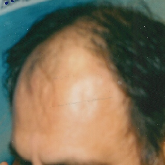 45-54 year old man treated with Hair Transplant before 3494798