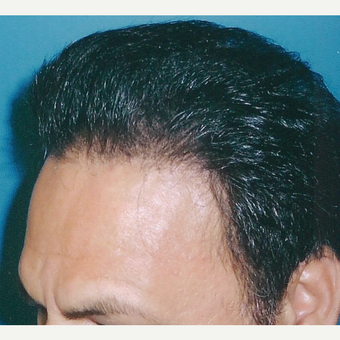 45-54 year old man treated with Hair Transplant after 3494798