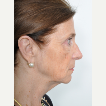 55-64 year old woman treated with Facelift before 3622396