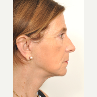 55-64 year old woman treated with Facelift after 3622396