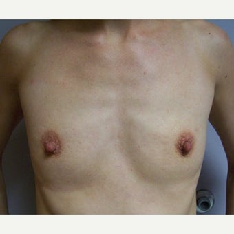 25-34 year old woman treated with Breast Augmentation before 1602218