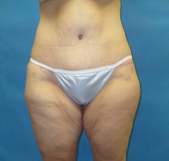 Body contouring after massive weight loss after 1420344