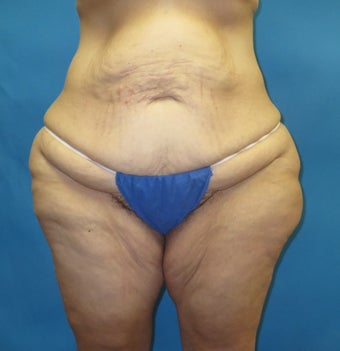 Body contouring after massive weight loss before 1420344