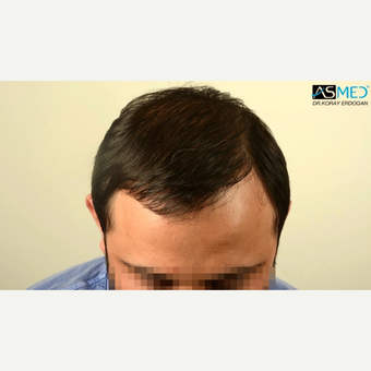 35-44 year old man treated with 4200 Grafts FUE Hair Transplant after 3091552