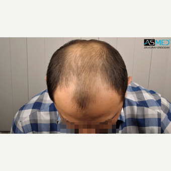 35-44 year old man treated with 4200 Grafts FUE Hair Transplant before 3091552