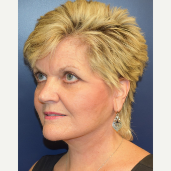 55-64 year old woman treated with Facelift after 3188089