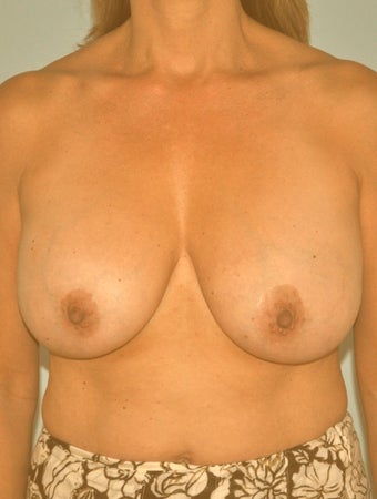 Implant removal with mastopexy for old implants before 1146166