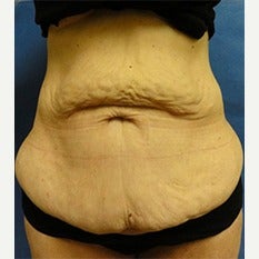 45-54 year old woman treated with Tummy Tuck before 1838680