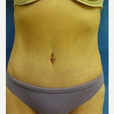 45-54 year old woman treated with Tummy Tuck after 1838680