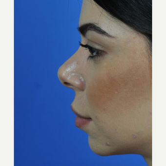 Open Revision Rhinoplasty before 3011182