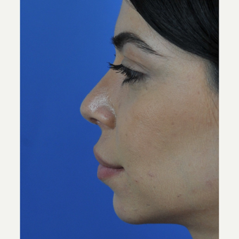 Open Revision Rhinoplasty after 3011182