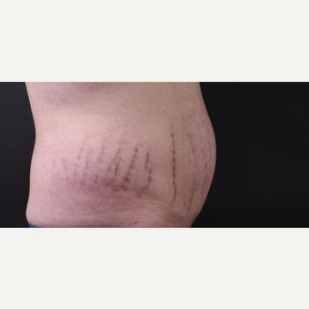 30 year old man treated with CoolSculpting before 3630357