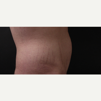 30 year old man treated with CoolSculpting after 3630357