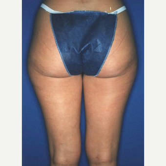Liposuction before 3346115