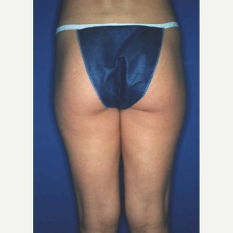 Liposuction after 3346115