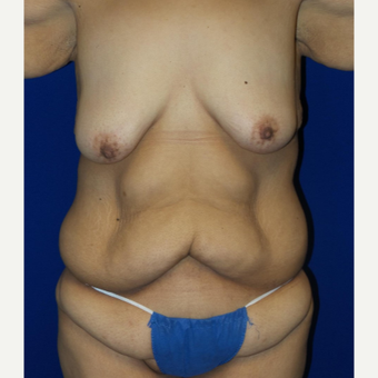 18-24 year old woman treated with Body Lift before 3253861