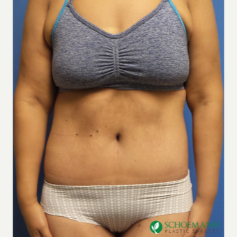 18-24 year old woman treated with Body Lift after 3253861
