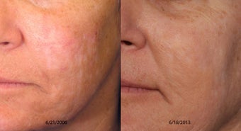 Scar Treatment Before and After before 1039844