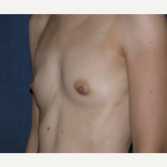35-44 year old woman treated with Breast Implants before 3455305
