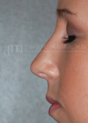 Rhinoplasty - Refine tip, Widen Dorsum 134440