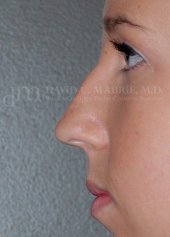 Rhinoplasty - Refine tip, Widen Dorsum 134440