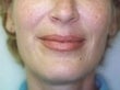 Female patient whose condition was corrected using radiesse after 928600