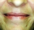 Female patient whose condition was corrected using radiesse 928600