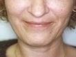 Female patient whose condition was corrected using radiesse before 928600