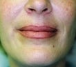 Female patient whose condition was corrected using radiesse 928600