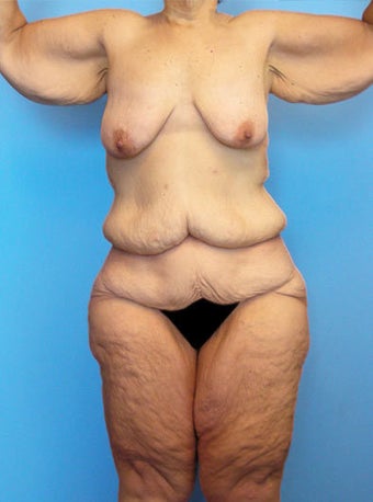 Body Lift before 216783