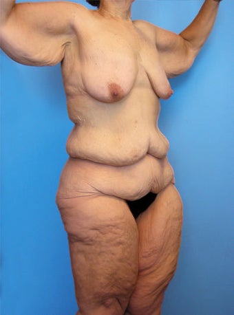Body Lift 216783