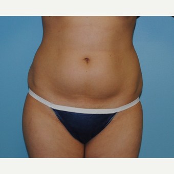 26 year old liposuction of abdomen and flanks before 3142623