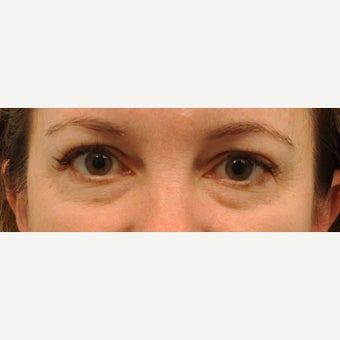 43 year old patient had Restylane to reduce under eye bags before 2220363