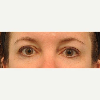 43 year old patient had Restylane to reduce under eye bags after 2220363