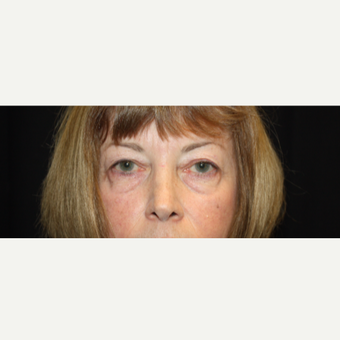55-64 year old woman treated with upper eyelid and lower eye bag treatment before 3325297