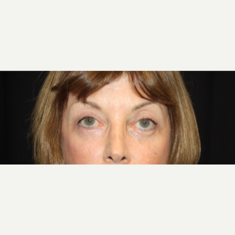 55-64 year old woman treated with upper eyelid and lower eye bag treatment after 3325297