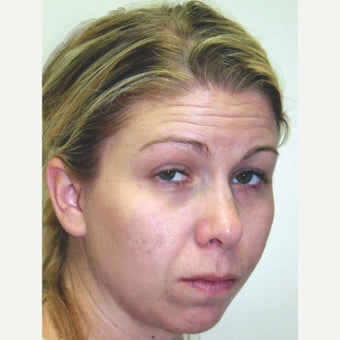 25-34 year old woman treated with Orthognathic Surgery before 1667477