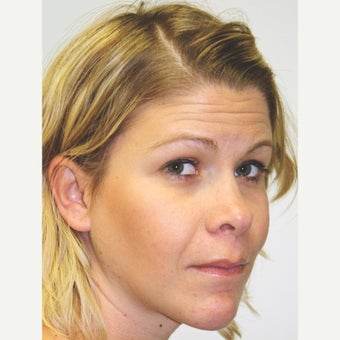 25-34 year old woman treated with Orthognathic Surgery after 1667477
