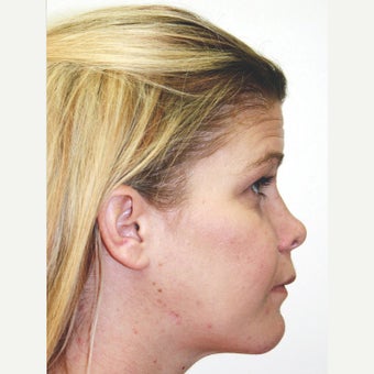 25-34 year old woman treated with Orthognathic Surgery 1667477