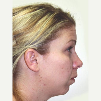 25-34 year old woman treated with Orthognathic Surgery 1667477