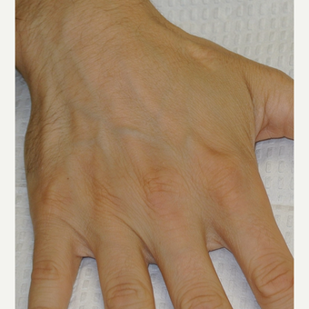 35-44 year old man treated with Voluma after 3120441