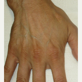 35-44 year old man treated with Voluma before 3120441