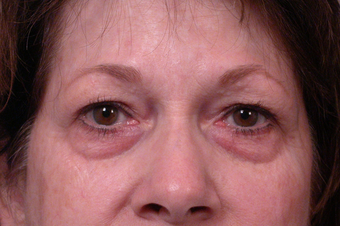 Eyelid Surgery before 302479