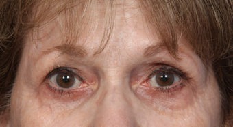 Eyelid Surgery after 302479