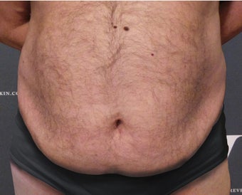 Coolsculpting treatment on the abdomen, flanks and upper chest before 3139857