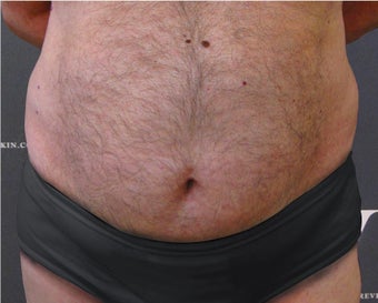 Coolsculpting treatment on the abdomen, flanks and upper chest after 3139857